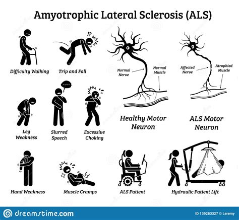 muestras y síntomas de la enfermedad del als de la esclerosis lateral amiotrófica ilustración