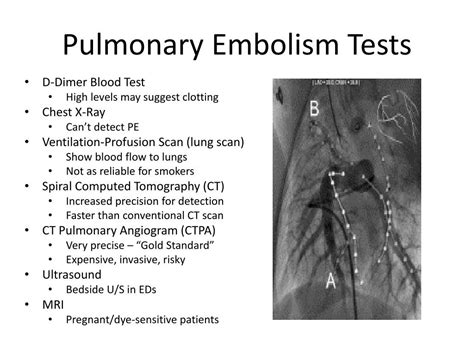 Ppt Group 1 Presentation Pulmonary Embolism Powerpoint Presentation