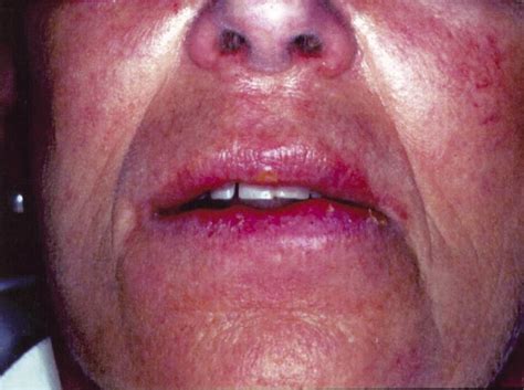 Multiple Suppurative Cystic Lesions Of The Lips And Buccal Mucosa A