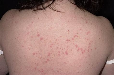 Early Symptoms Of Psoriasis Pictures Symptoms And Pictures