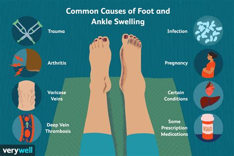Common Causes Of Foot And Ankle Swelling The Best Porn Website