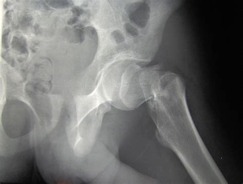 Hip Fractures In Older Adults An Important Source Of Morbidity