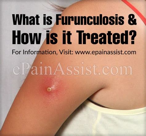 What Is Furunculosis And How Is It Treated With Images Foliculitis