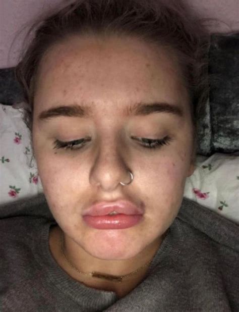 Womans Confidence Shattered After Lip Fillers Spread Across Her Face
