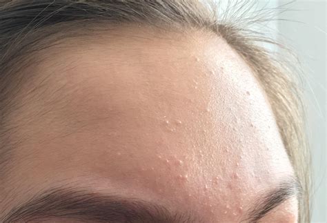 what are these tiny white bumps on your face and how