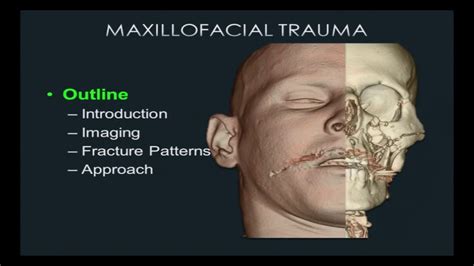 Face Trauma Ct Emergency Radiology Youtube