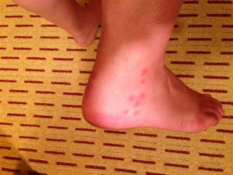 Bed Bug Bites On Ankle Picture Of Anaheim Marriott Suites Garden