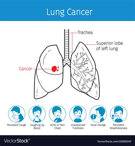 These problems are called paraneoplastic syndromes. Human lungs outline and lung cancer symptoms Vector Image
