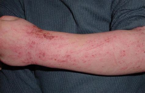 Hydro Dermatitis Eczema Free Skin
