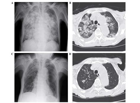 Diagnostic Delay Of Pulmonary Tuberculosis In Patients With Acute