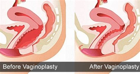 Virgin Tightening Surgery Before And After Pictures A Comprehensive Guide Healthy B Daily