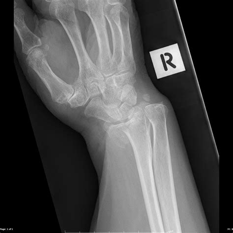 Reverse Barton fracture | Image | Radiopaedia.org