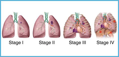 Lung Cancer Staging Modern Cancer Hospital Guangzhou China