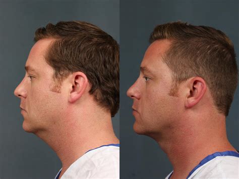 Neck Procedures Before And After Photos Patient 726 Louisville Ky