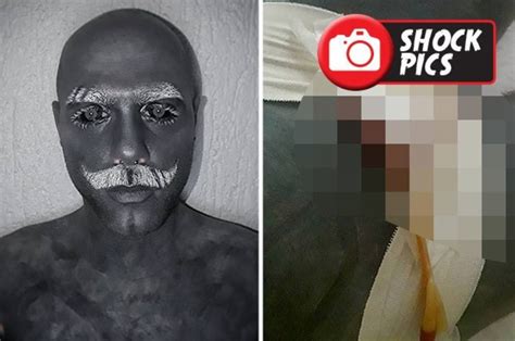 Tattooed Man Adam Curlykale Reveals Shock Post Op Pics After Penis