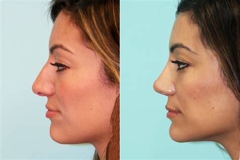 Non Surgical Rhinoplasty Photos Chevy Chase Md Patient 18779