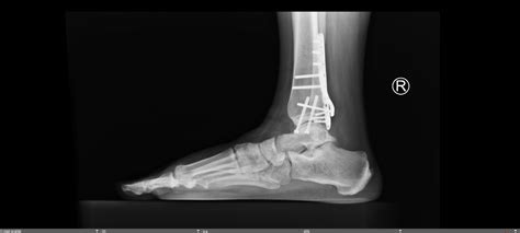 Trimalleolar Ankle Fracture — Chicago Foot And Ankle Orthopaedic Surgeons