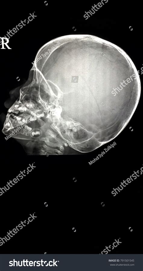 Normal Skull Xray Pediatrics Patient Stock Photo 791501545 Shutterstock