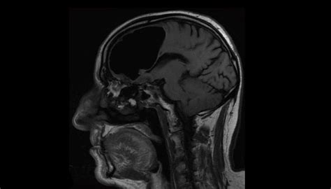 Large Gaping Hole Discovered In Irish Man S Brain Newshub