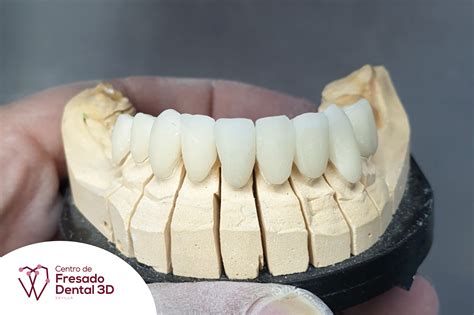 Características De Las Coronas Dentales Centro De Fresado Dental 3d