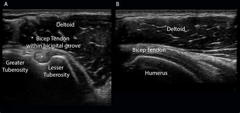 Cureus A Stepwise Guide To Performing Shoulder Ultrasound The