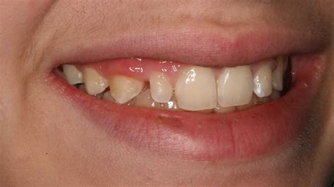 Restoring The Peg Lateral Incisor