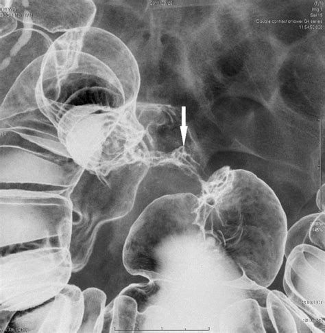 Double Contrast Barium Enema Showing An Apple Core Lesion Over The