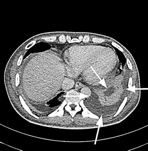 Abdominal Computed Tomography Ct Scan Showing Splenic Rupture White