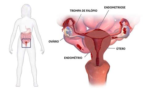 Endometriose ist eine häufige, gutartige, oft schmerzhafte chronische erkrankung von frauen, bei welcher der gebärmutterschleimhaut (dem endometrium) ähnliches gewebe außerhalb der gebärmutterhöhle (ektop) vorkommt. Cirurgia para Endometriose | Gastro Serv