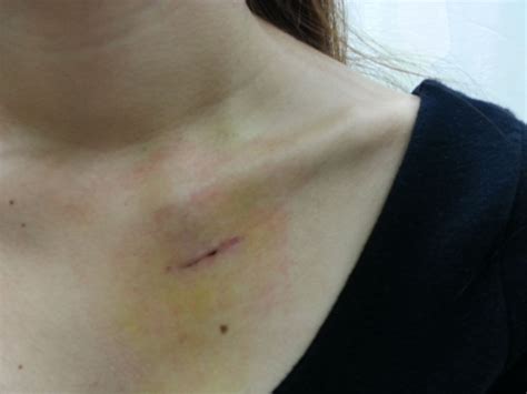 Broken Collarbone Surgery Singapore Clavicle Fixation