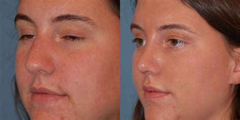 Open Rhinoplasty 1 Month Dr M Been The Center For Facial Plastic