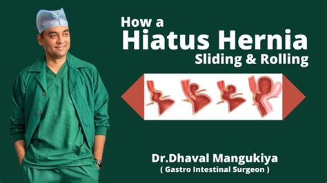 How A Hiatus Hernia Sliding Rolling Is Formed Symptoms And Treatment Dr Dhaval Mangukiya