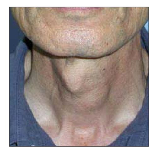 Figure 1 From Laryngeal Deviation Condition Mimicking Submucosal Tumor