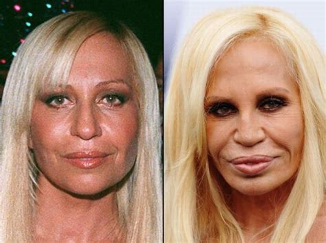 Celebrities Before And After A Plastic Surgery Pics