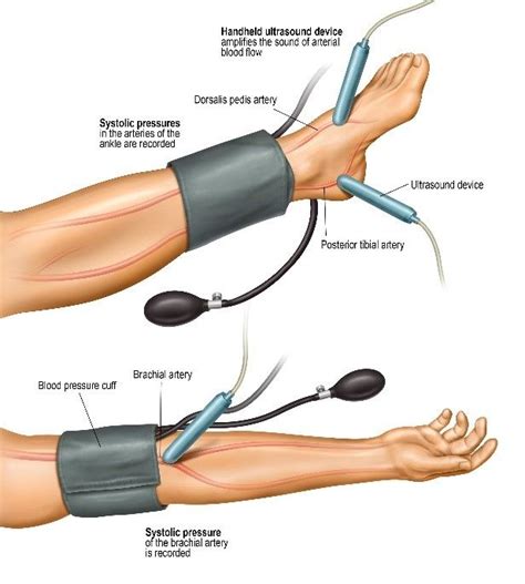 The wrist pulse is the radial pulse; September Is Peripheral Artery Disease Awareness Month | Azura