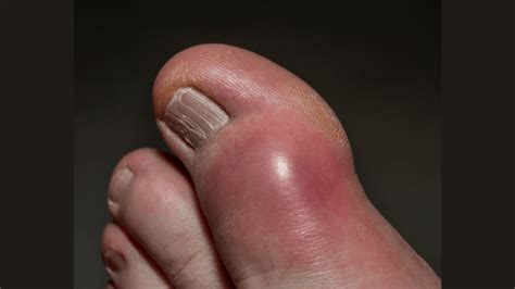 Pictures Of The Gout Symptoms Food To Avoid Other Tips
