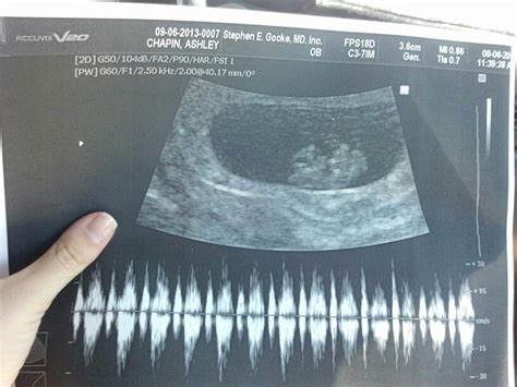 8 Weeks And 1 Day Pregnant First Ultrasound Baby Stuhr Has A