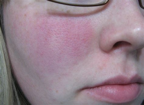 Bug Bite Looking Bumps That Itch Rosacea And Facial Redness