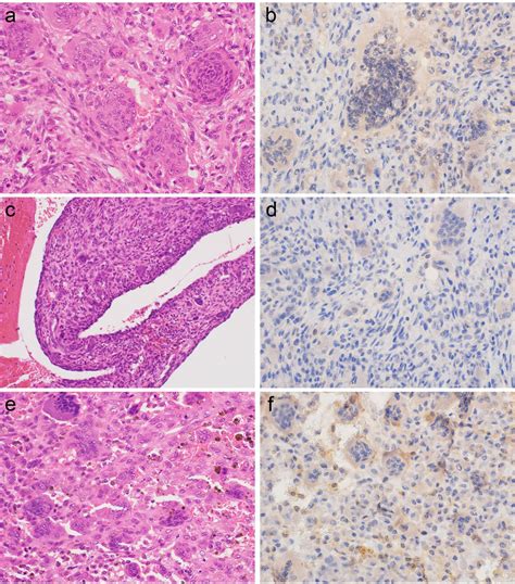 Histology And Csf1 Immunohistochemistry Of Giant Cell Tumor Of Bone