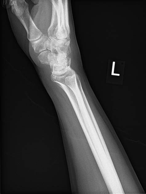 Fracture Of The Radial Styloid Process With Scapholunate Dissociation