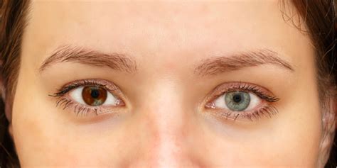 Heterochromia American Academy Of Ophthalmology