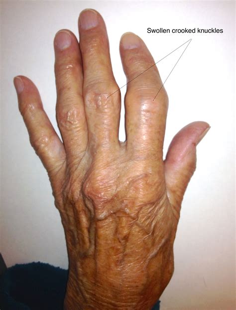 Hands Arthritis Auckland Orthopaedicsauckland Orthopaedics