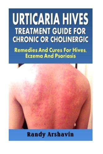 Urticaria Hives Treatment Guide For Chronic Or Cholinergic Remedies