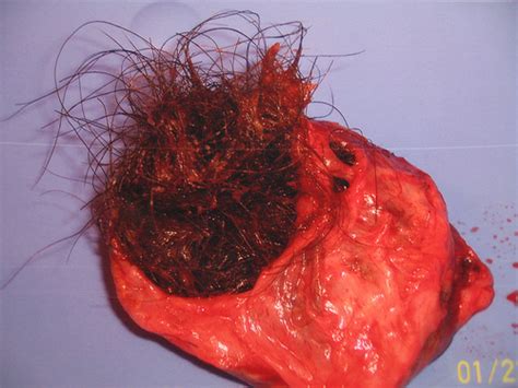 A doctor may surgically remove an ovarian cyst that is causing. Womb Twin Survivors: A dermoid cyst or teratoma: is my ...