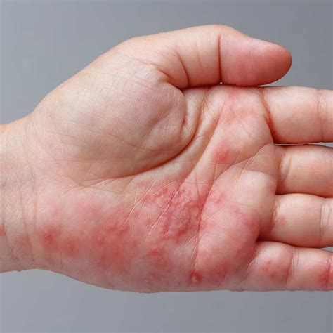 Hand Rash — Fora Dermatology General And Surgical Dermatology In