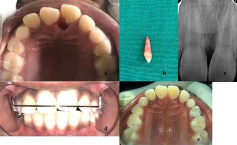 2a Atraumatic Extraction Of Supernumerary Tooth2b Extracted