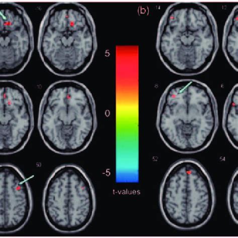 Functional Magnetic Resonance Imaging Scans Showing Changes In Resting