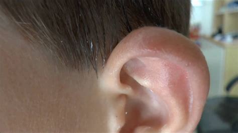 Ear Swelling And Redness Following An Insect Bite Youtube