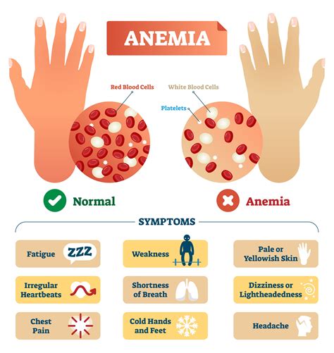 Iron Deficiency Anemia Symptoms