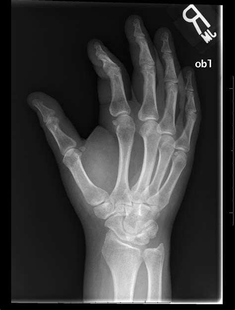 Archive Of Unremarkable Radiological Studies Right Hand X Ray Stepwards